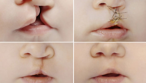 cleft-lip-surgery-procedure